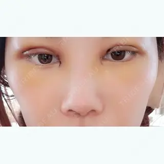 3日目の経過画像（1枚目）