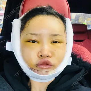 4日目の経過画像（1枚目）