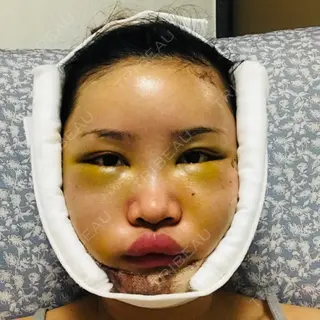 4日目の経過画像（3枚目）