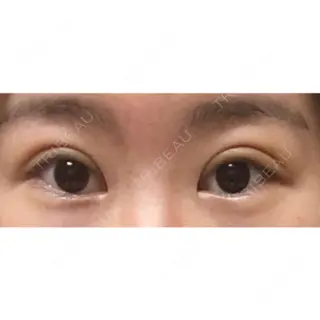 14日目の経過画像（1枚目）