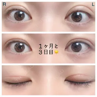 33日目の経過画像（1枚目）