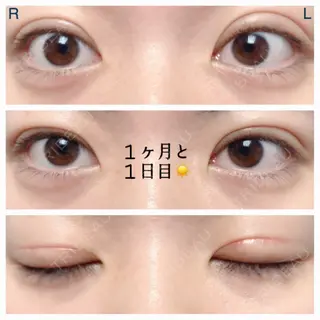 31日目の経過画像（1枚目）