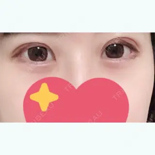 44日目の経過画像（1枚目）