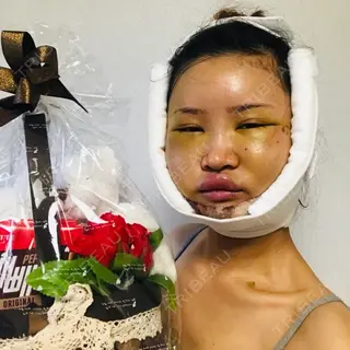 5日目の経過画像（2枚目）