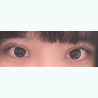 0日目の経過画像（1枚目）