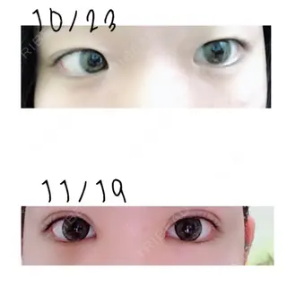 35日目の経過画像（2枚目）