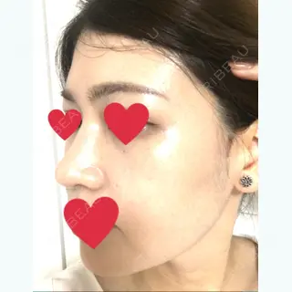 15日目の経過画像（3枚目）
