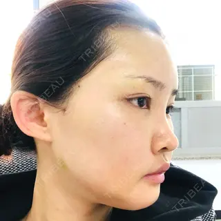 9日目の経過画像（1枚目）
