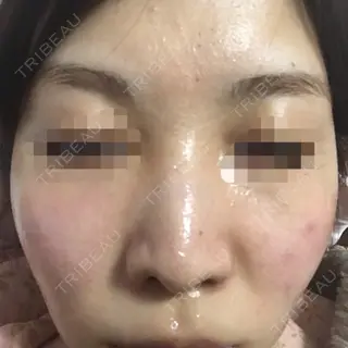 0日目の経過画像（2枚目）