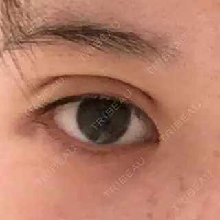 0日目の経過画像（2枚目）