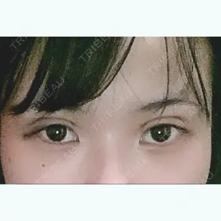 0日目の経過画像（1枚目）
