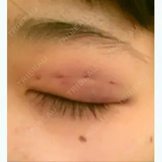 0日目の経過画像（3枚目）