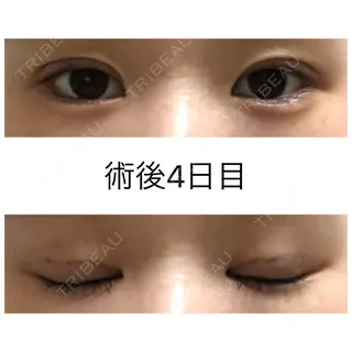3日目の経過画像（1枚目）