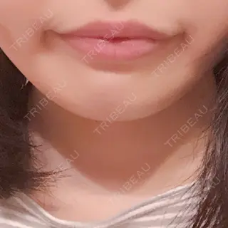 14日目の経過画像（1枚目）