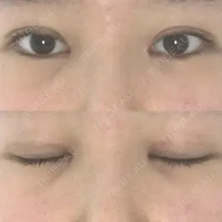 14日目の経過画像（1枚目）