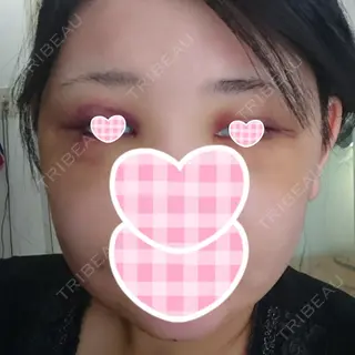 3日目の経過画像（1枚目）