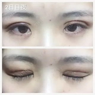 2日目の経過画像（2枚目）