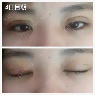 4日目の経過画像（1枚目）