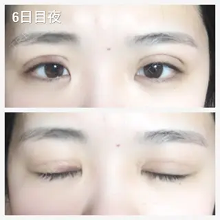 6日目の経過画像（2枚目）