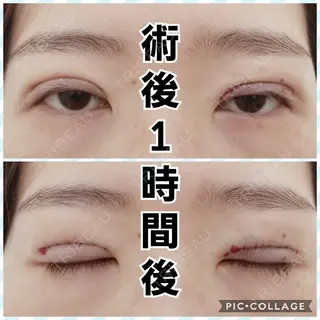 0日目の経過画像（1枚目）