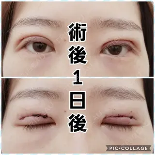 1日目の経過画像（1枚目）