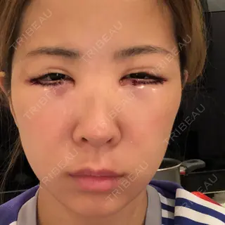 0日目の経過画像（2枚目）