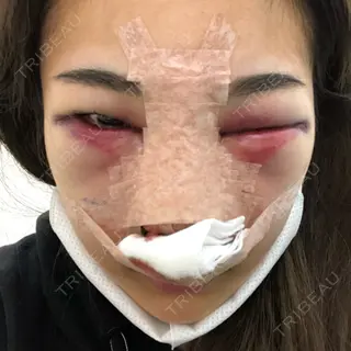 1日目の経過画像（1枚目）
