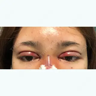1日目の経過画像（1枚目）