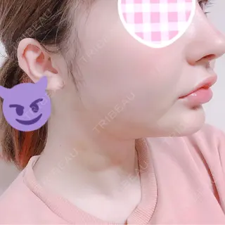 3日目の経過画像（2枚目）