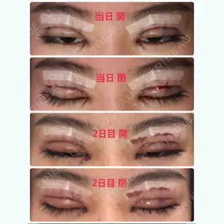 1日目の経過画像（1枚目）
