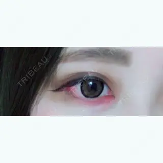 8日目の経過画像（3枚目）