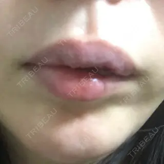 7日目の経過画像（1枚目）