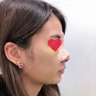 6日目の経過画像（3枚目）