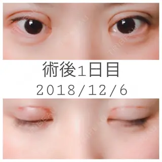 1日目の経過画像（1枚目）