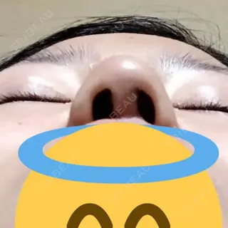6日目の経過画像（3枚目）
