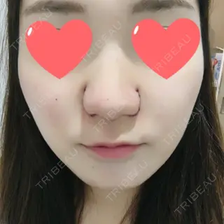 0日目の経過画像（1枚目）