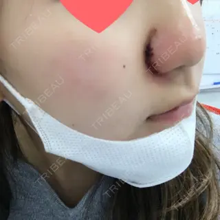 2日目の経過画像（3枚目）