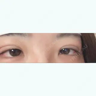 1日目の経過画像（1枚目）