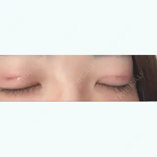 1日目の経過画像（2枚目）