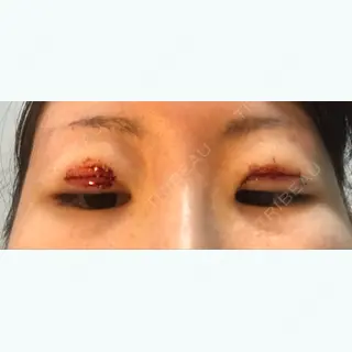 0日目の経過画像（3枚目）