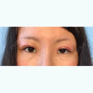 1日目の経過画像（1枚目）