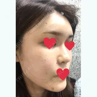 0日目の経過画像（2枚目）