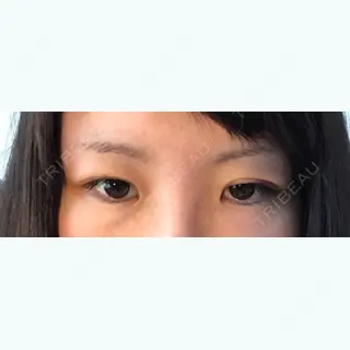 4日目の経過画像（2枚目）