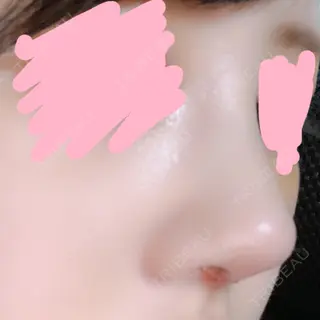 5日目の経過画像（1枚目）