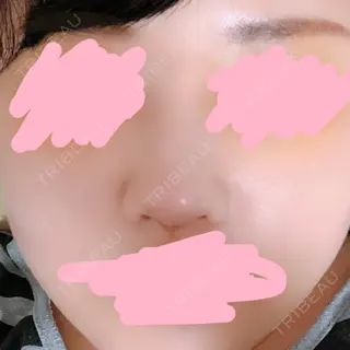 5日目の経過画像（3枚目）