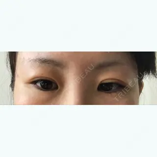 5日目の経過画像（2枚目）