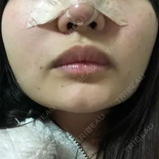 1日目の経過画像（1枚目）