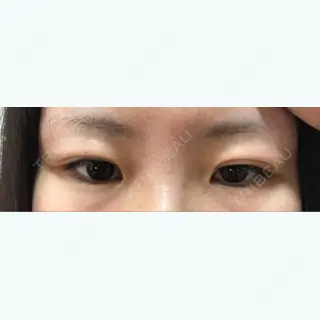 11日目の経過画像（2枚目）