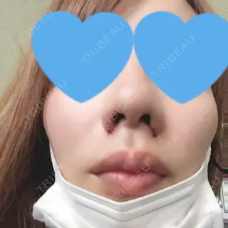 1日目の経過画像（3枚目）