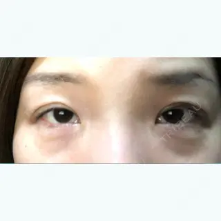 0日目の経過画像（1枚目）